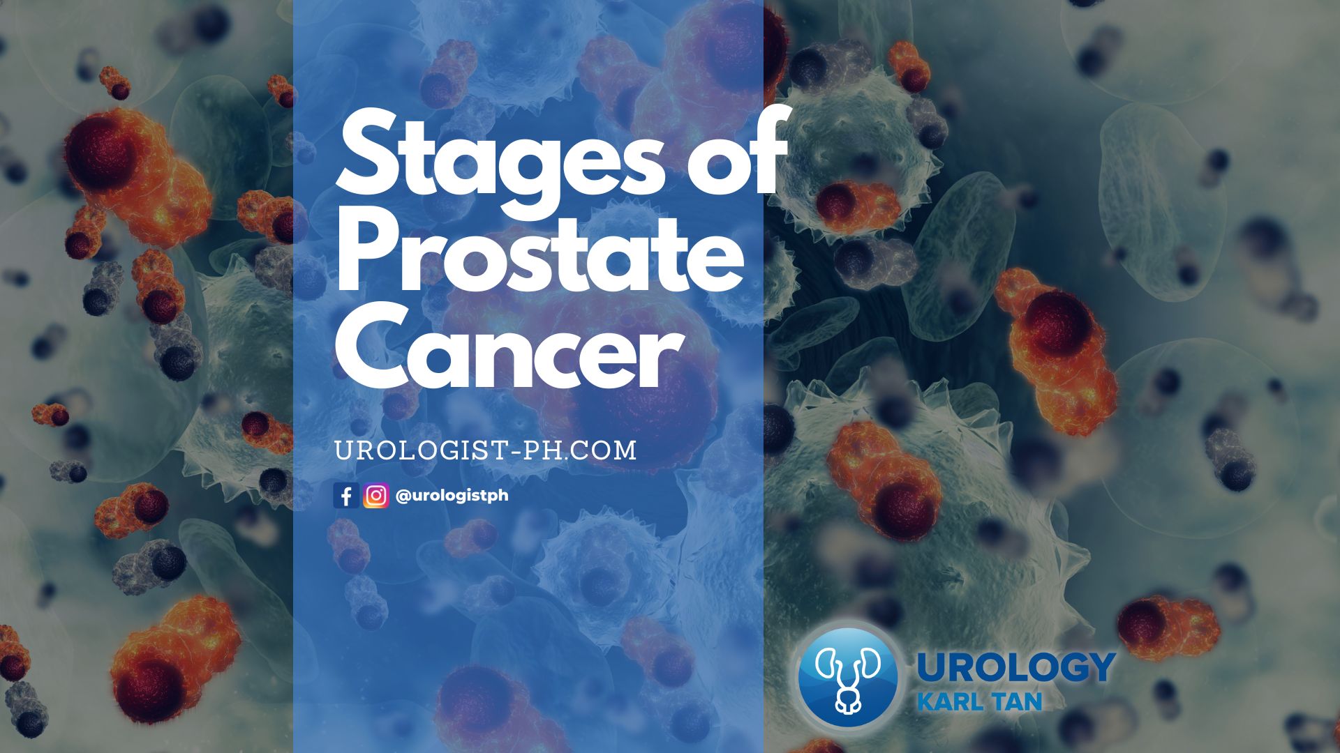 Stages Of Prostate Cancer | Karl Marvin M. Tan, MD, MMHoA, FPUA